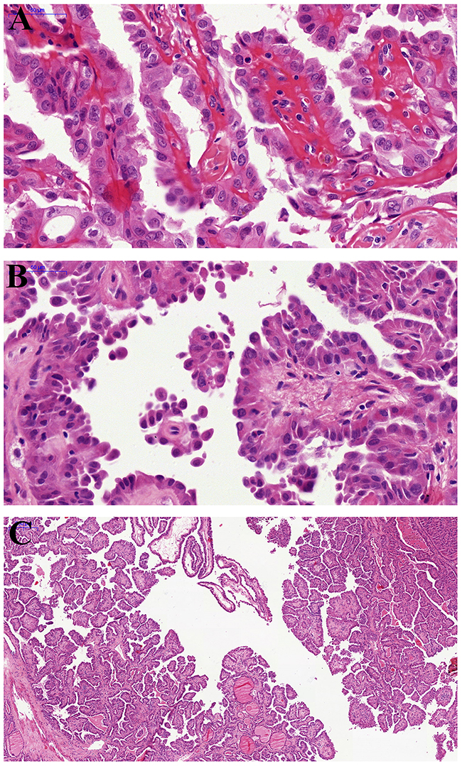 Pathological findings of hobnail variant papillary thyroid carcinoma.