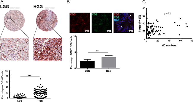 Immune cell infiltration in the glioma microenvironment: MCs as potential modulators of SRGN expression in GBM.