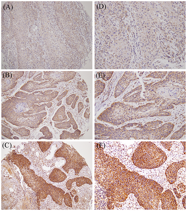 MMP-11 expression in primary oral cancer.