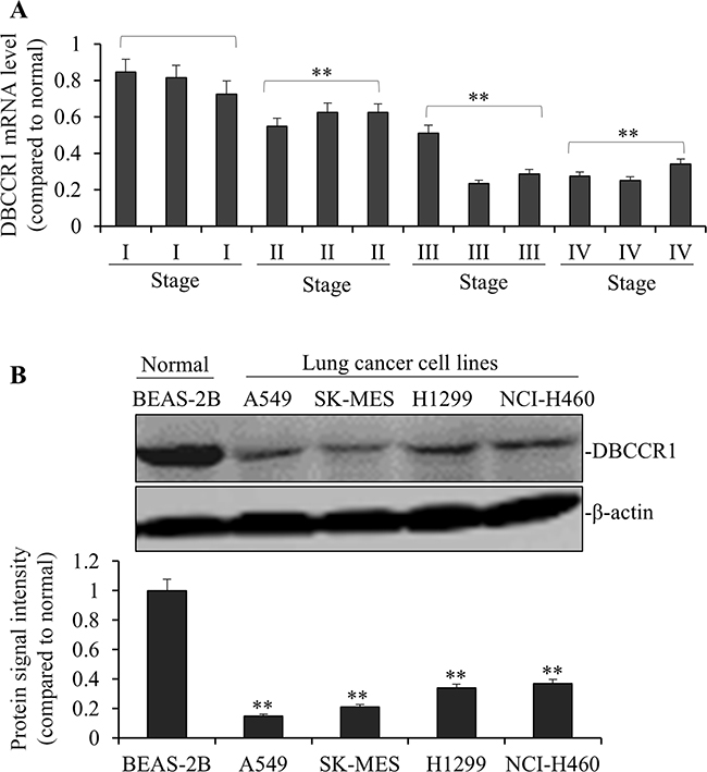 DBCCR1 expression was low in both patient tissue and lung cancer cell lines.
