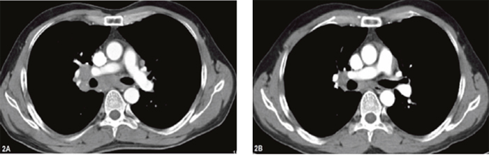 Chest computed tomography of the patient (case 1) before and after gefitinib.