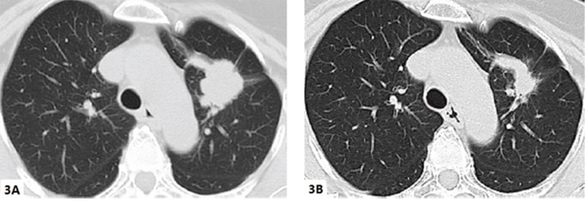 Chest computed tomography of the patient (case 2) before and after icotinib.