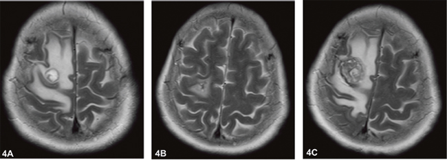 Magnetic resonance imaging of brain showed the mass located in the frontal lobe for Case 2.