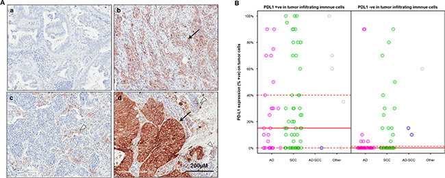 PD-L1 expression on tumor cells (TC) and tumor infiltrating immune cells (IC) in Chinese NSCLC patients.