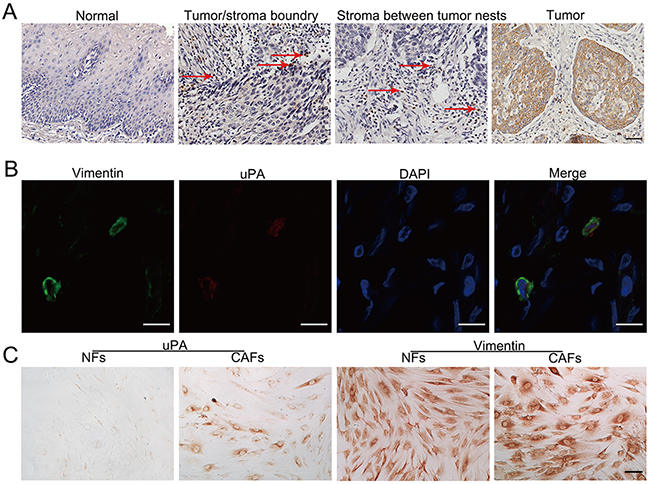 Distribution of uPA positive cells in primary ESCC tissues.