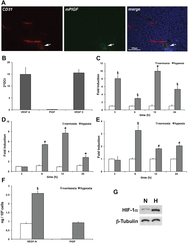 PlGF is expressed in low CD31 positive tumor vessels and hypoxia activates its expression in LECs.