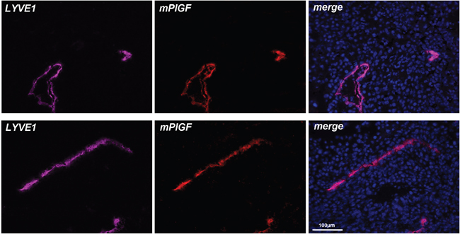 PlGF is expressed in LYVE1 positive tumor lymphatic vessels.