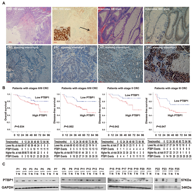 PTBP1 is highly expressed in colorectal cancer and high expression of PTBP1 is associated with poor prognosis.