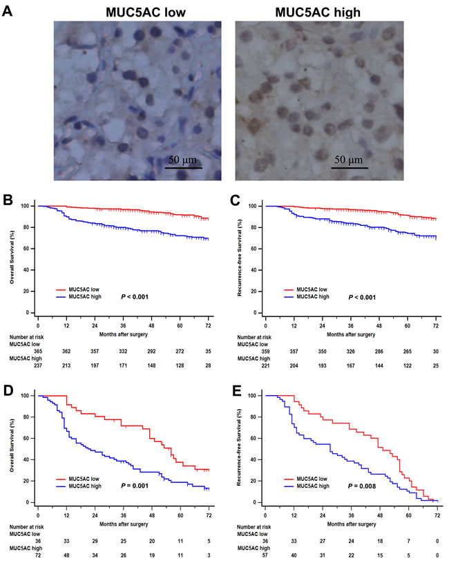 Immunohistochemical MUC5AC expression and its association with clinical outcomes of patients with clear-cell renal cell carcinoma (ccRCC).