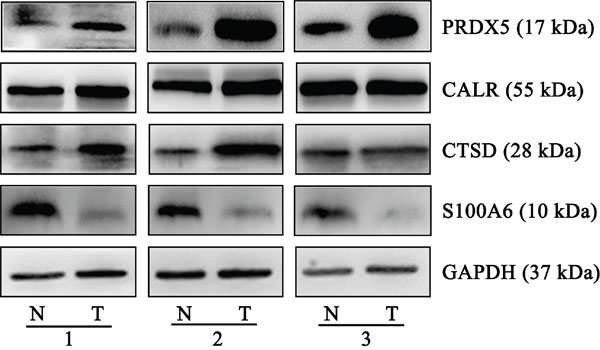 Representative western blots of PRDX5, CALR, CTSD and S100A6 in gastric cancer and normal tissues.