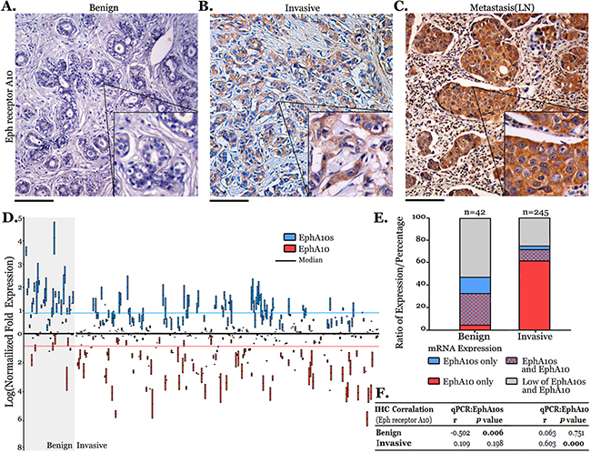 EPHA 10 expression in breast cancer.