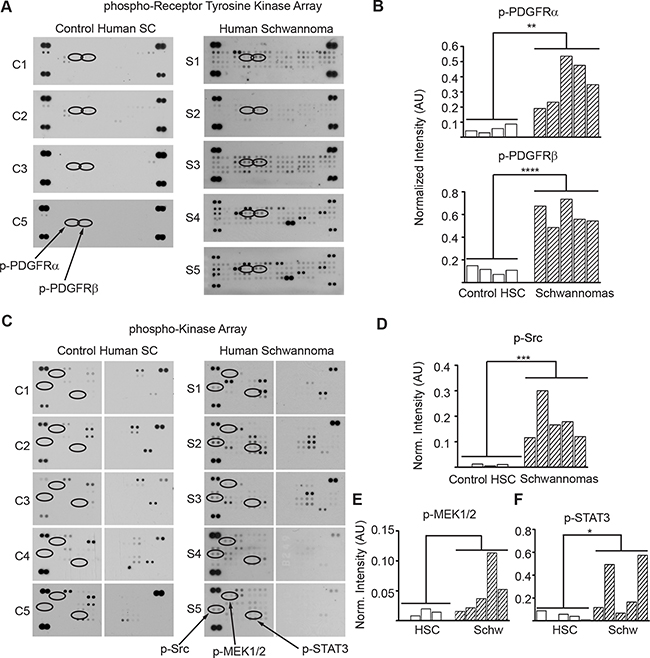 PDGFR&#x03B1;/&#x03B2;, SRC, MEK and STAT3 are overactive in human schwannomas.