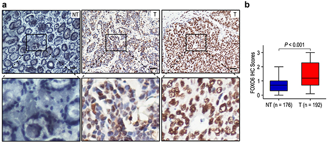 FOXO6 was significantly over-expression in gastric cancer.
