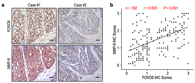FOXO6 and MMP-9 levels correlated in 192 gastric cancer tissues.
