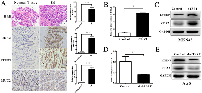 hTERT was closely related with the expression of CDX2 in GIM and gastric cancer cells.