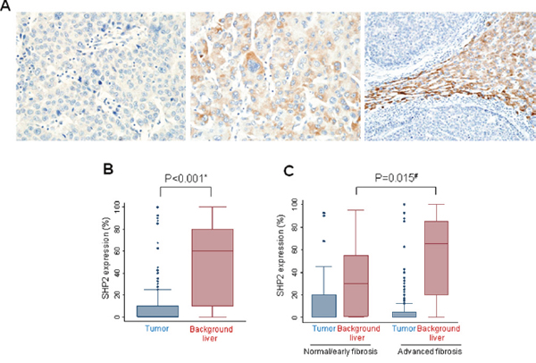 Immunohistochemical detection of SHP2 expression in human HCCs.