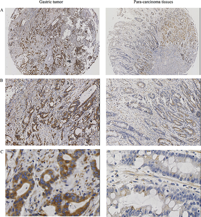 UBE2T protein expression in gastric tumors and para-carcinoma tissues.