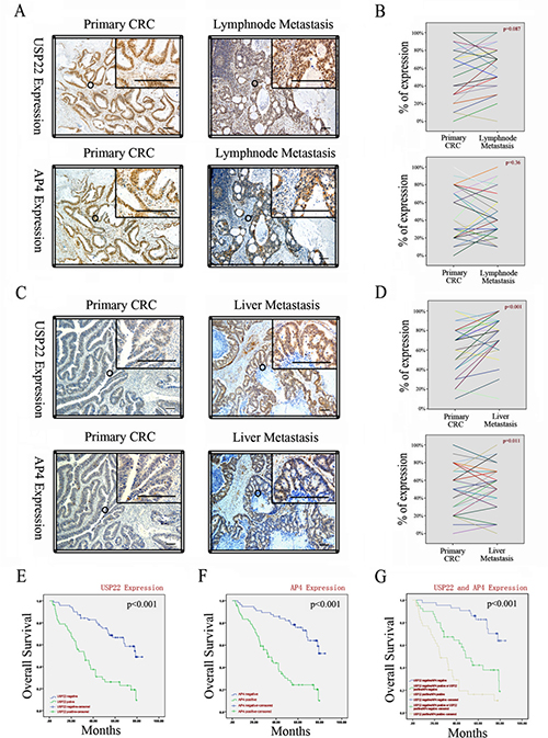 USP22 and AP4 are associated with metastasis of CRC and poor patient survival.