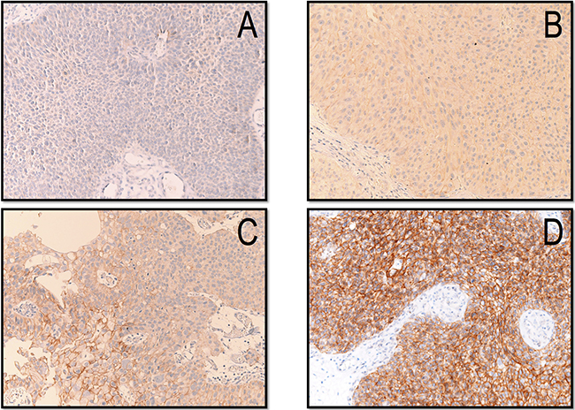 Immunohistochemical expression of HER-2 scored as 0-absence of staining (A), 1+ (B), 2+ (C) and 3+ (D).