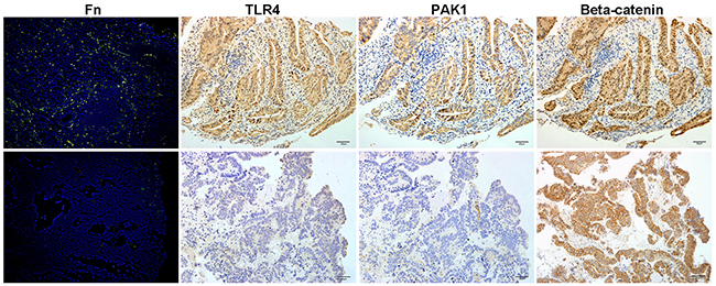 Invasive Fn in CRC tissues is associated with an activated &#x03B2;-catenin signaling pathway and TLR4/PAK1 protein abundance.