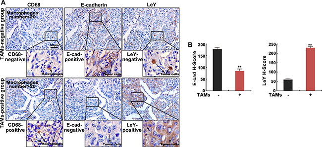 The density of TAMs correlates with E-cadherin level and LeY level in human lung adenocarcinoma tissues.