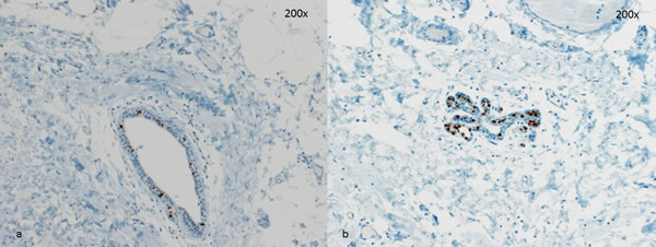 Two representative cases for PR staining.
