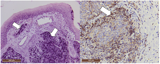 Positive controls: EBER positivity in a nasopharyngeal carcinoma (NPC) with EBER-ISH (deeper purple, mostly nuclear staining, arrows).