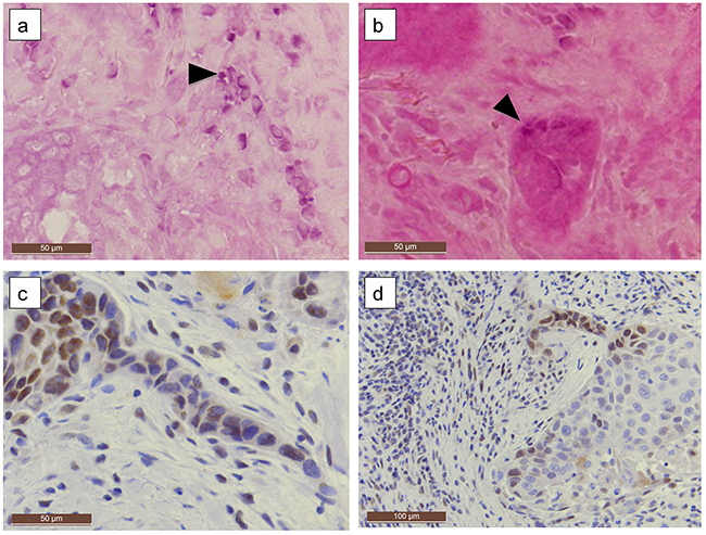 HPV genotype 6 positive tongue SCC.