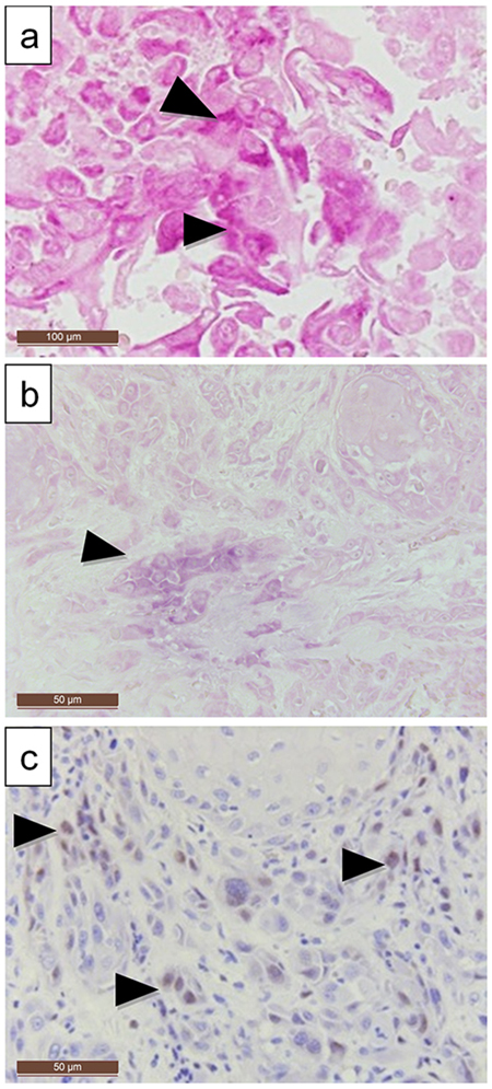 LMP-1 expression compared to EBER expression in a larynx carcinoma.