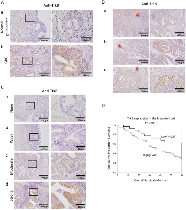 Immunohistochemical analysis of TrkB in primary gallbladder cancer (GBC).