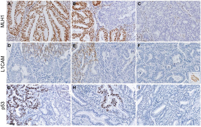 Representative figures of discordant MLH1, L1CAM and p53 protein expression in three endometrium carcinoma cases.