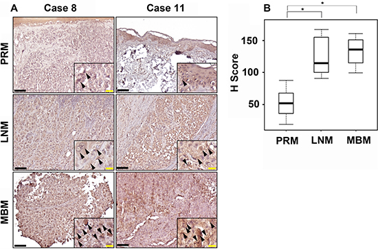 CCR4 expression during melanoma progression to brain metastasis.