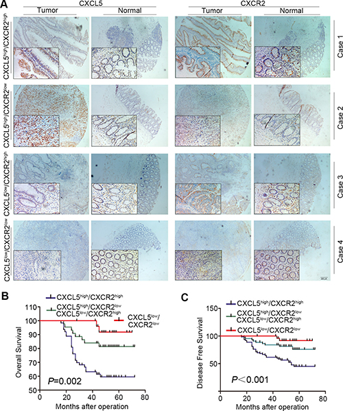 Combination of CXCL5 and CXCR2 to predict prognosis on CRC patients.