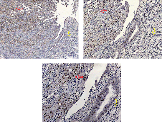 Immunohistochemical staining of BRD4 protein in gastric carcinoma (red arrow) and adjacent normal tissue (yellow arrow).