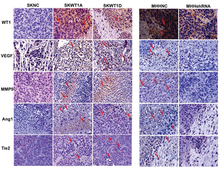 WT1 enhances expression of pro-angiogenic molecules.