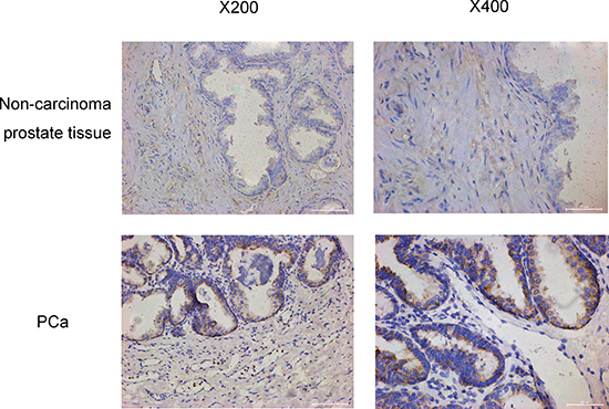The oxytocin receptor expression in no-carcinoma prostate tissue and the PCa tissue.