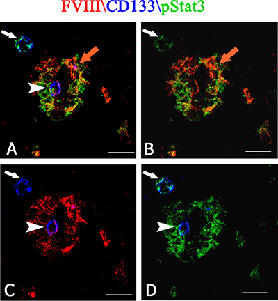 Multiple FVIII (red), CD133 (blue) and pStat3 (green) confocal immunofluoresce reaction.