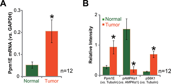 Ppm1E upregulation in human gastric cancer tissues.