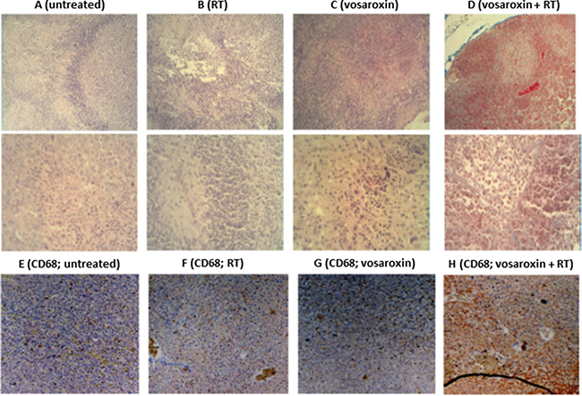 Leukocyte infiltration with vosaroxin and/or RT.