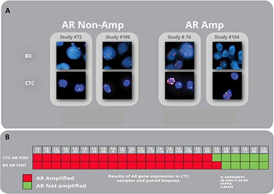 AR amplification in matched CTCs and biopsies from mCRPC patients.