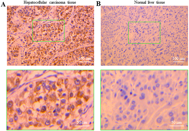 Expression of the P2Y11 receptor in human hepatocellular carcinoma and normal live tissues.