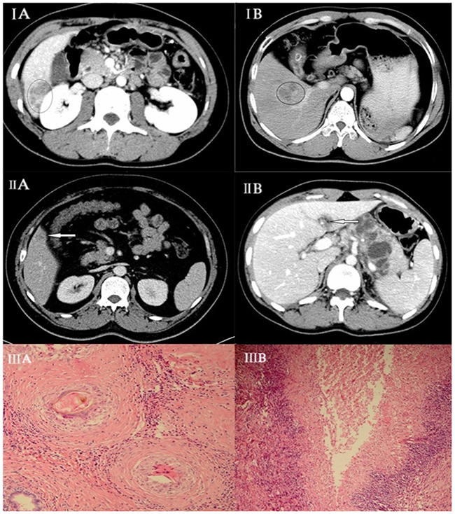 (IA) Hepatic paragonimiasis in a 50-year-old male patient.