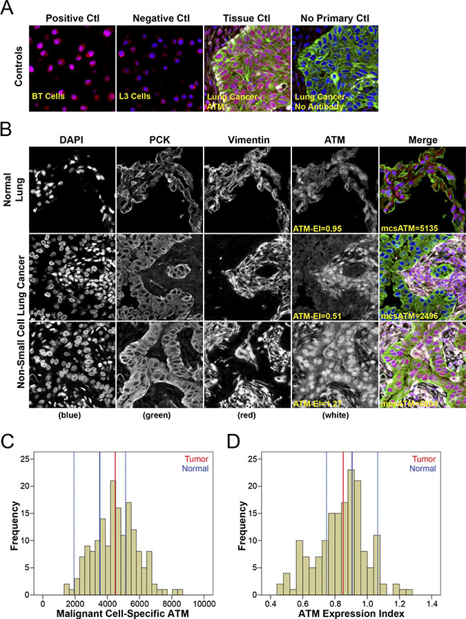 Quantitative fluorescence immunohistochemistry and digital image analysis for ATM in NSCLC.