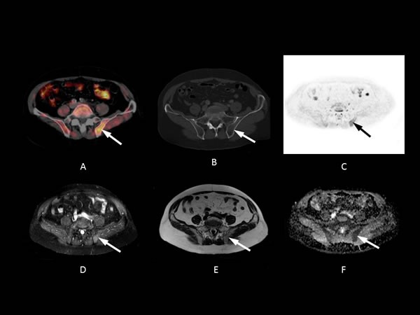 54-year-old patient with bone metastasis in the left pelvis nine years after radical prostatectomy (initial Gleason Score: 8).