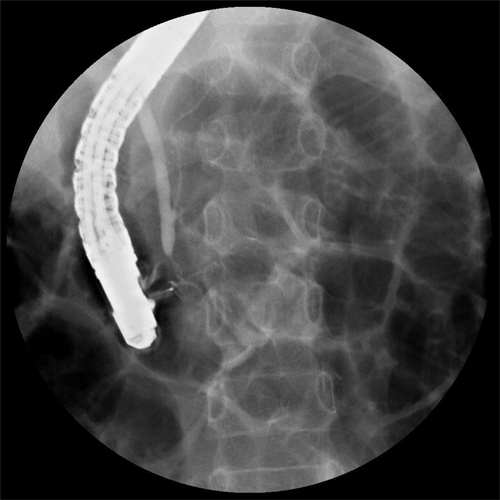 Representative fluoroscopic image of a patient with a Komi type b PBM.