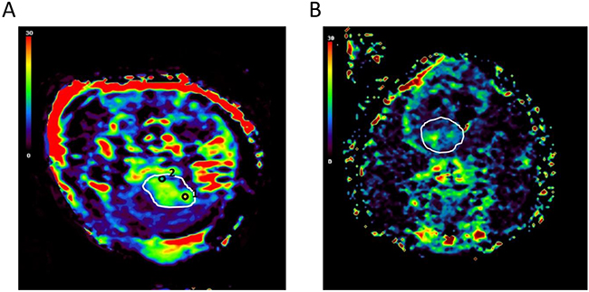 Regional heterogeneity within brain tumors.