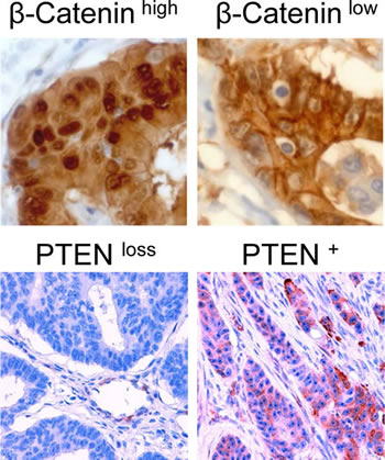 Immunohistochemical staining of colon carcinomas using anti-&#x3b2;-Catenin antibody (400-fold magnification) or anti-PTEN antibody (200-fold magnification).