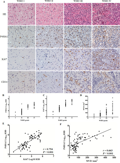 P4HA1 is overexpressed in high-grade gliomas and is correlated with Ki67 and MVD in human glioma specimens.