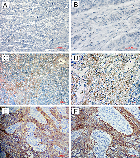 Immunohistochemical staining for FAP&#x03B1; in ESCC tissues.