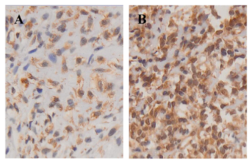 Immunohistochemical images show the different expression of VEGFR-2 in 2 osteosarcoma patients.